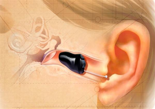 कान नहर में लगाई कान की सबसे छोटी मशीन blog image