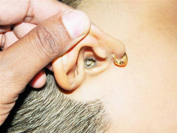 कान का मैल के संचय के कारण बहरापन