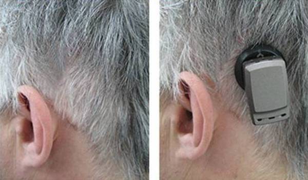 BAHA or Bone Conduction Implant. Conductive hearing loss blog image
