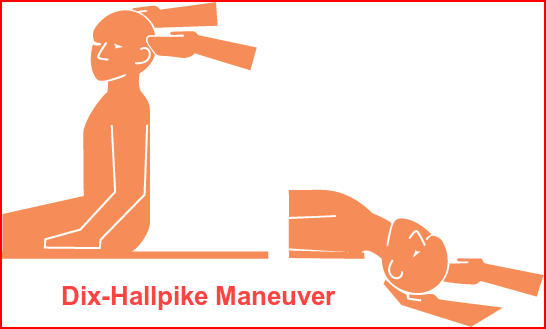Standard Dix-Hallpike maneuver_blog Image