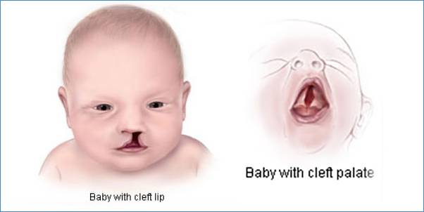 Cleft Lip and Cleft Palate blog image