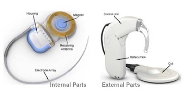 Cochlear Implant Parts blog image