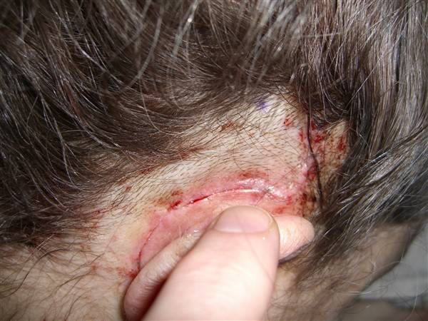 Healed Scar after Cochlear Implant Surgery blog image