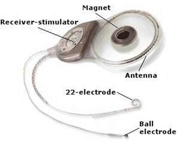 Internal Parts of the Cochlear Implant blog feature image