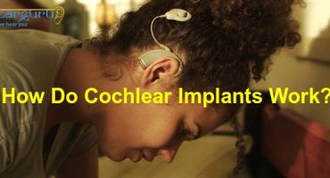 How Do Cochlear Implants Work?