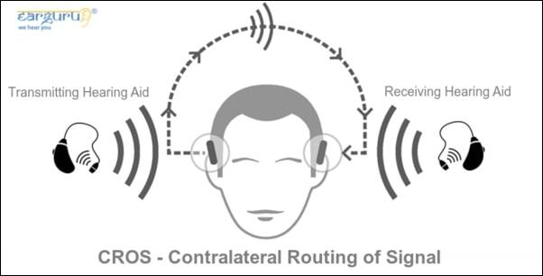 CROS Hearing Aid- contralateral routing of signal blog image of hearing loss in one ear