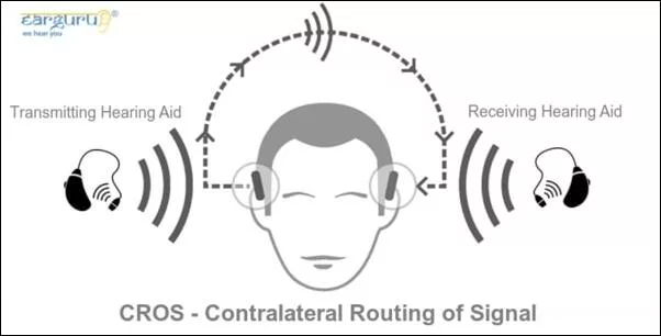 CROS Hearing Aid- contralateral routing of signal blog image of hearing loss in one ear
