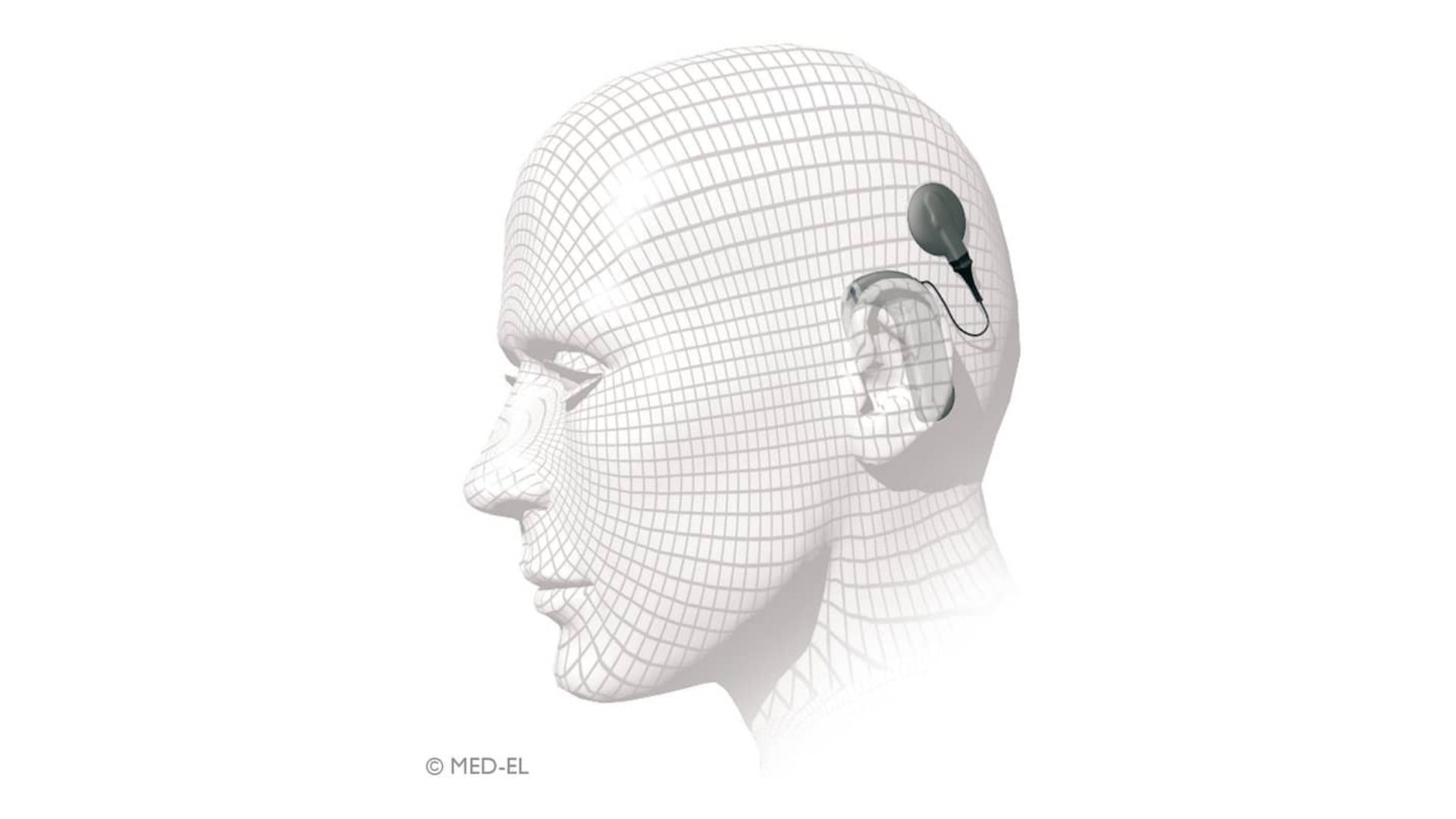 Frequently asked questions about cochlear implants. blog feature image
