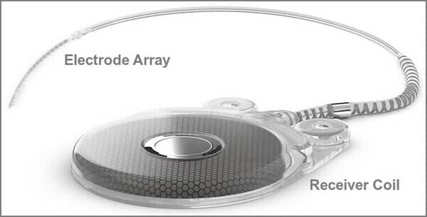 Internal Parts of the Cochlear Implant blog image