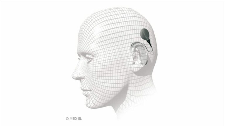 Frequently asked questions about cochlear implants. blog feature image