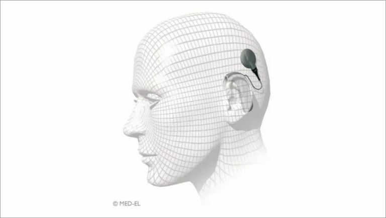 Frequently asked questions about cochlear implants. blog feature image