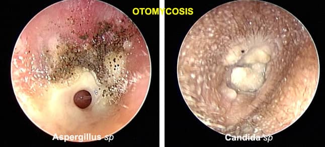 fungal infection behind ear