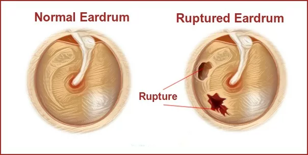 Normal eardrum and ruptured eardrum. Blog image
